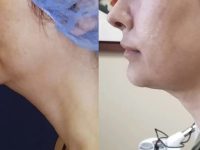 neck-tightening-neck-lift-laser