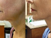 necktite-facetite-before-after