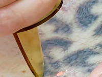 q-switched-tattoo-removal