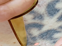 q-switched-tattoo-removal