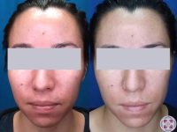 redness-of-the-face-rosacea-treatment-before-after