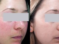 redness-on-cheeks-treatment