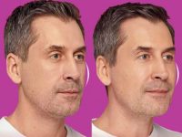 restylane-before-and-after-filler-6