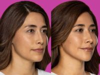 restylane-before-and-after-filler-7