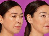 restylane-filler-before-and-after