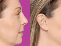 restylane-filler-cheeks