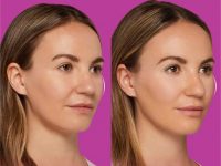 restylane-under0eyes0filler