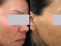 rosacea-seborrheic-dermatitis-face-dark-skin