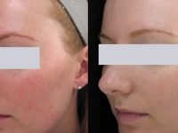 rosacea-treatment-before-after-2