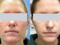 rosacea-treatment-before-after