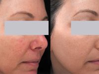 rosacea-treatment-before-and-after