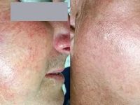 rosaceaBeforeAndAfterSM-1