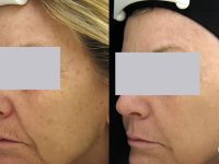 spectralift-before-and-after-3-laser-facelift-treatments