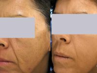 spectralift-laser-facelift-3