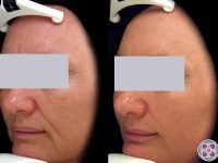 spectralift-laser-facelift
