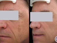 spectralift-nonsurgical-facelift-spot-removal-wrinkle-remover