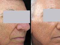 spectrlift-male-veins-spots