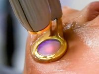 spider-vein-removal-with-ktp-laser
