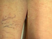 spider-veins-legs-removal-with-laser-treatment