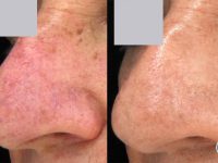 spider-veins-redness-nose