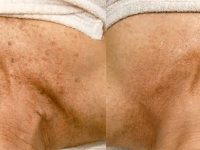 spots-on-chest-laser-removal