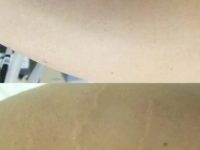 stretch-mark-removal-before-after-2 (2)