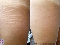stretch-mark-removal-before-after-2