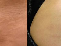 stretch-mark-removal-before-after
