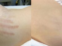 stretch-mark-removal-laser-treatment-before-and-after