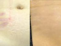 stretch-mark-removal