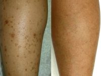 sun-spots-on-legs-removed-with-laser-treatment-before-and-after