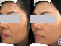 sun-spots-removal-on-the-face-before-and-after-treatment