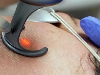 the-co2-laser-helps-build-collagen-to-keep-rocesea-away