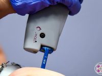 v-beam-pulsed-dye-laser-for-rosacea