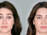 young-female-before-and-after-botox-cosmetic